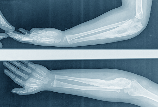 A child x-ray elbow Lateral, AP view of the forearm caused by bone cancer(osteosarcoma) of the ulna.